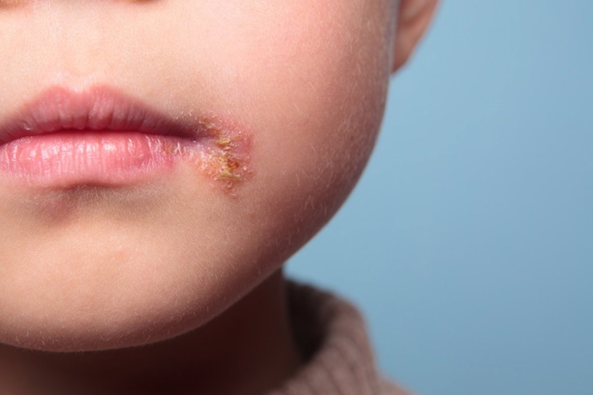 Impetigo